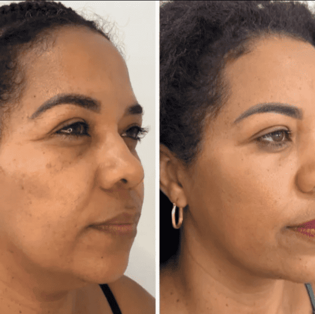 Collagen Fit™ - Máscara Rejuvenescedora de Colágeno