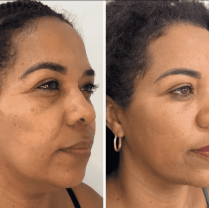 Collagen Fit™ - Máscara Rejuvenescedora de Colágeno