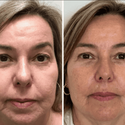 Collagen Fit™ - Máscara Rejuvenescedora de Colágeno