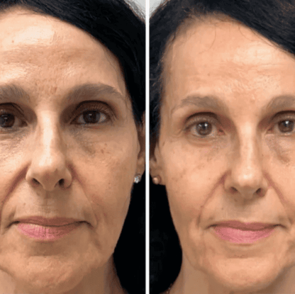 Collagen Fit™ - Máscara Rejuvenescedora de Colágeno